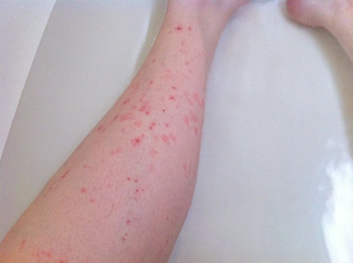 Rashes+on+arms+only